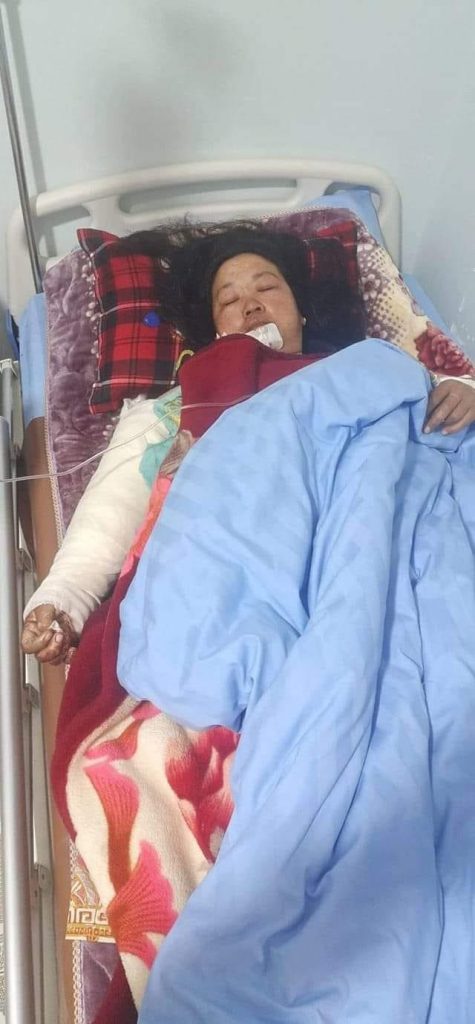 လေယာဥ်ဗုံးစထိမှန် နမ့်ခမ်းဒေသခံ လက်ဖြတ်တောက် ကုသဖို့ အကူအညီလိုအပ်နေ