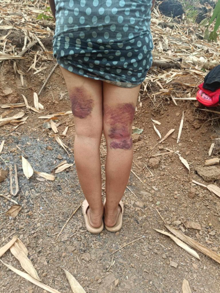 CDM သူနာပြုတစ်ဦး မတရားသဖြင့် ကြိမ်ဒဏ်ပေးခံရ