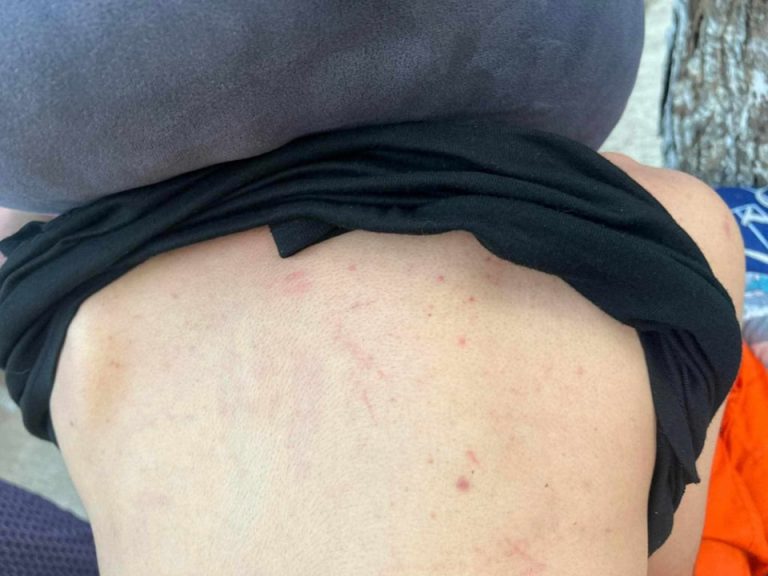 ငလျင်ကြောင့် သေဆုံးသူအလောင်းများ ကိုင်တွယ်သည့် ကယ်ဆယ်ရေးသမားတချို့ ခန္ဓာကိုယ်အနှံ့ အနီစက်ထွက်