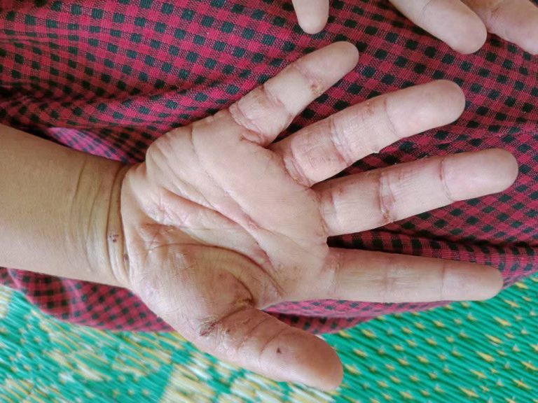 စစ်ရှောင်စခန်းများတွင် အရေးပြားရောဂါများ ကုသရန်ခက်ခဲ