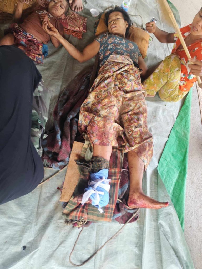 မင်းကင်း လေယာဉ်ဗုံးကြဲခံရ၍ ဒဏ်ရာရသူများ ဆေးရုံပို့ရာတွင် ခက်ခဲနေ